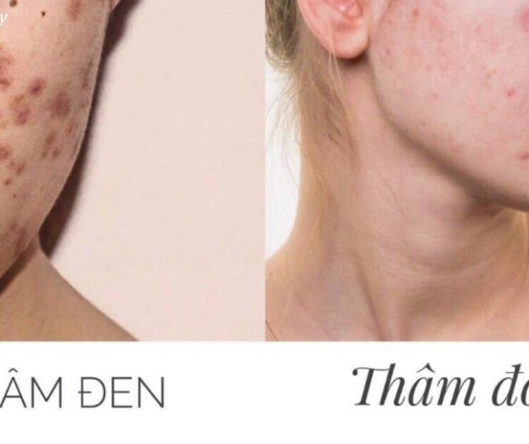 Tại Sao Thâm Đỏ Sau Mụn Lại Khó Lành Hơn Vết Thâm Nâu
