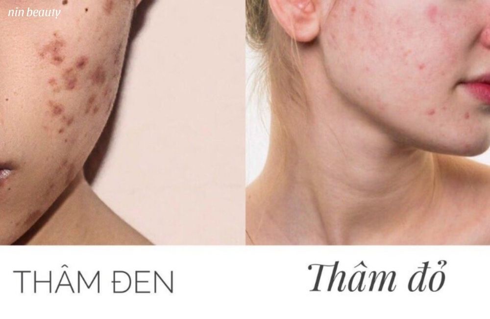 Tại Sao Thâm Đỏ Sau Mụn Lại Khó Lành Hơn Vết Thâm Nâu
