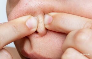 Giải Quyết Triệt Để Mụn Đầu Đen Và Sợi Bã Nhờn Bằng Phương Pháp Nào? 3 Giải Quyết Triệt Để Mụn Đầu Đen Và Sợi Bã Nhờn Bằng Phương Pháp Nào?