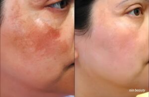 Cách Sử Dụng Kem Nám ElixirLab Để Phục Hồi Làn Da Nám Lâu Năm