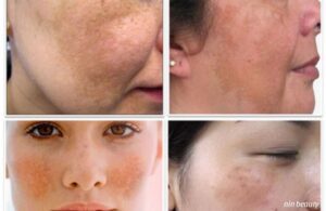 Tại Sao Da Càng Khô Lại Dễ Nám Và Lão Hóa Và Đây Là Cách Chăm Sóc Hiệu Quả 2 Tại Sao Da Càng Khô Lại Dễ Nám Và Lão Hóa Và Đây Là Cách Chăm Sóc Hiệu Quả