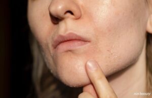 Tại Sao Da Càng Khô Lại Dễ Nám Và Lão Hóa Và Đây Là Cách Chăm Sóc Hiệu Quả 3 Tại Sao Da Càng Khô Lại Dễ Nám Và Lão Hóa Và Đây Là Cách Chăm Sóc Hiệu Quả