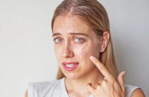 5 Điều Cần Lưu Ý Làn Da Trong Ngày Tết Để Da Không Bùng Mụn