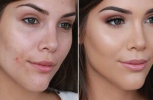 5 Điều Cần Lưu Ý Làn Da Trong Ngày Tết Để Da Không Bùng Mụn