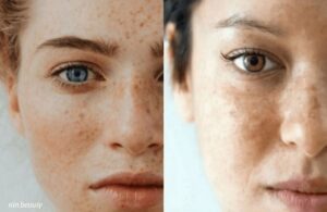 Nám Mảng Hay Nám Chân Sâu Bạn Đã Biết Cách Phân Biệt? 3 Nám Mảng Hay Nám Chân Sâu Bạn Đã Biết Cách Phân Biệt?