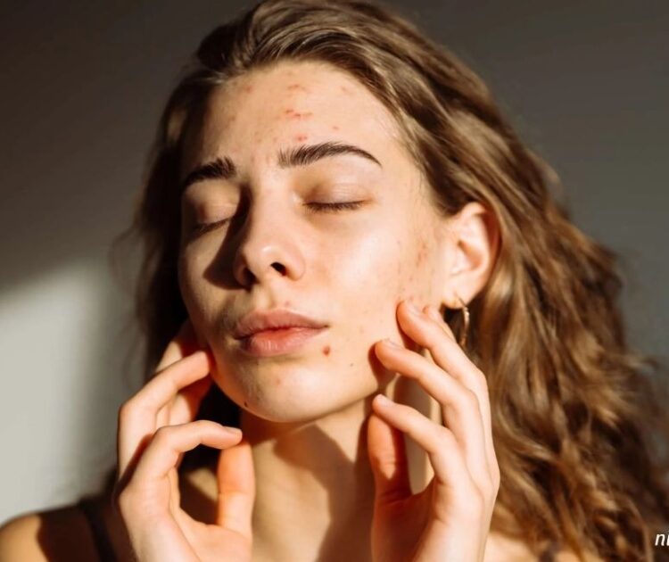 Những Lý Do Khiến Cho Vòng Lặp Mụn Mãi Không Kết Thúc Trên Làn Da Bạn
