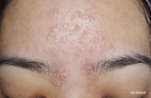 Lý Do Da Mọc Nhiều Mụn Trắng Vào Mùa Nồm? Chuẩn Đoán Da Tại Nhà