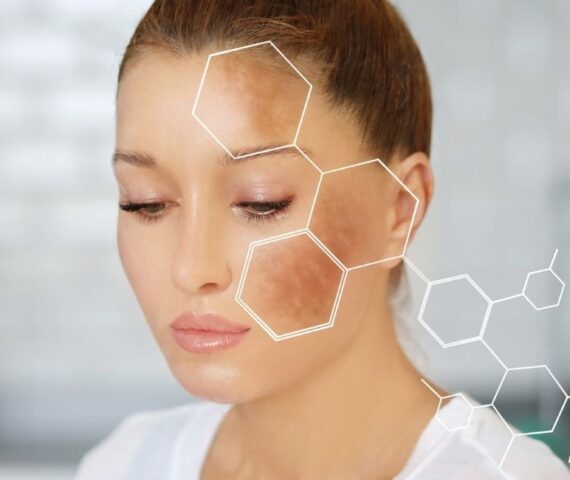 Nền Da Yếu Thủ Phạm Chính Gây Nám Da Bạn Đã Biết?