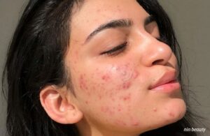 Làm Thế Nào Để Nhận Biết Da Đang Bùng Mụn Hay Đẩy Mụn?