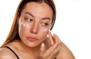 Giải Mã Cơ Chế Tái Phát Nám? Tại Sao Nám Rất Dễ Quay Trở Lại Sau Điều Trị?