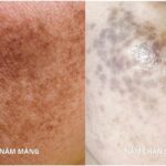 Nám Mảng Hay Nám Chân Sâu Bạn Đã Biết Cách Phân Biệt? 5 Nám Mảng Hay Nám Chân Sâu Bạn Đã Biết Cách Phân Biệt?