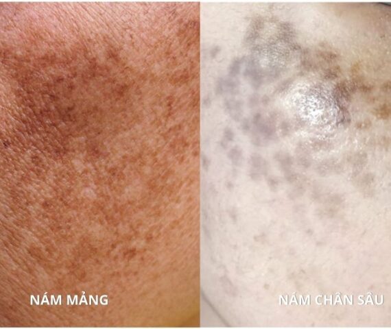 Nám Mảng Hay Nám Chân Sâu Bạn Đã Biết Cách Phân Biệt?