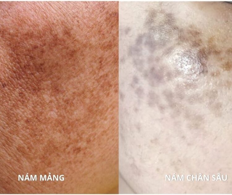 Nám Mảng Hay Nám Chân Sâu Bạn Đã Biết Cách Phân Biệt?