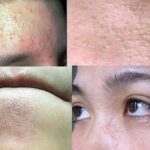 Lý Do Da Mọc Nhiều Mụn Trắng Vào Mùa Nồm? Chuẩn Đoán Da Tại Nhà 5 Lý Do Da Mọc Nhiều Mụn Trắng Vào Mùa Nồm? Chuẩn Đoán Da Tại Nhà