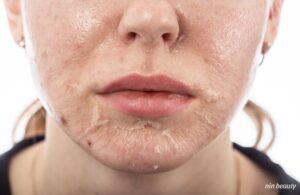 Càng Peel Lỗ Chân Lông Càng To? Liệu Bạn Đã Sai Ở Đâu?