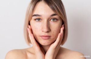 Những Lý Do Khiến Cho Vòng Lặp Mụn Mãi Không Kết Thúc Trên Làn Da Bạn