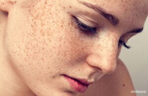 Nền Da Yếu Thủ Phạm Chính Gây Nám Da Bạn Đã Biết?