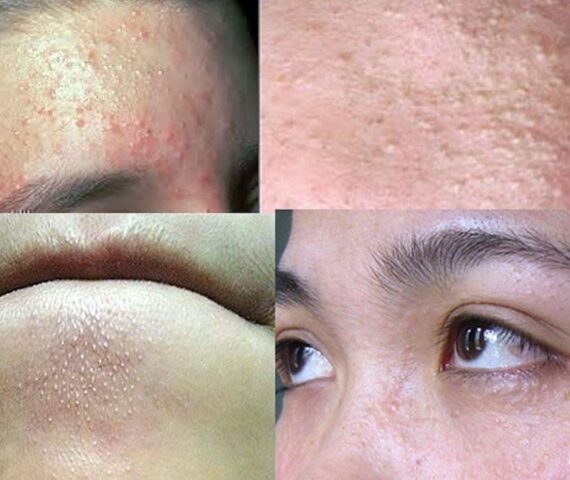 Lý Do Da Mọc Nhiều Mụn Trắng Vào Mùa Nồm? Chuẩn Đoán Da Tại Nhà