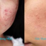 Làm Thế Nào Để Nhận Biết Da Đang Bùng Mụn Hay Đẩy Mụn?