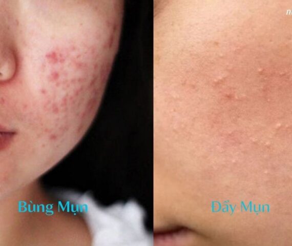 Làm Thế Nào Để Nhận Biết Da Đang Bùng Mụn Hay Đẩy Mụn?