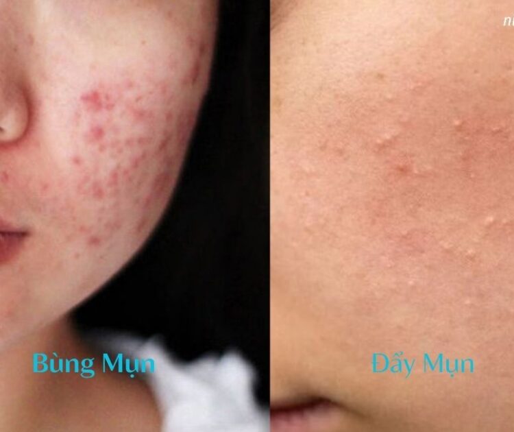 Làm Thế Nào Để Nhận Biết Da Đang Bùng Mụn Hay Đẩy Mụn?