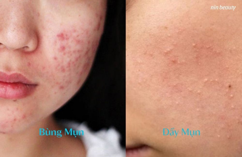 Làm Thế Nào Để Nhận Biết Da Đang Bùng Mụn Hay Đẩy Mụn?