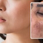 Giải Mã Cơ Chế Tái Phát Nám? Tại Sao Nám Rất Dễ Quay Trở Lại Sau Điều Trị?