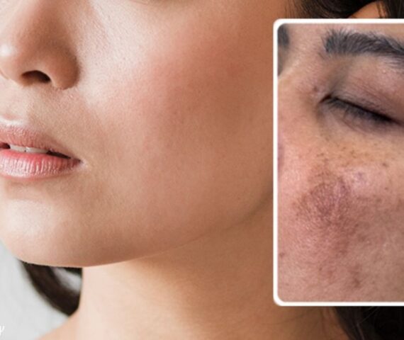 Giải Mã Cơ Chế Tái Phát Nám? Tại Sao Nám Rất Dễ Quay Trở Lại Sau Điều Trị?