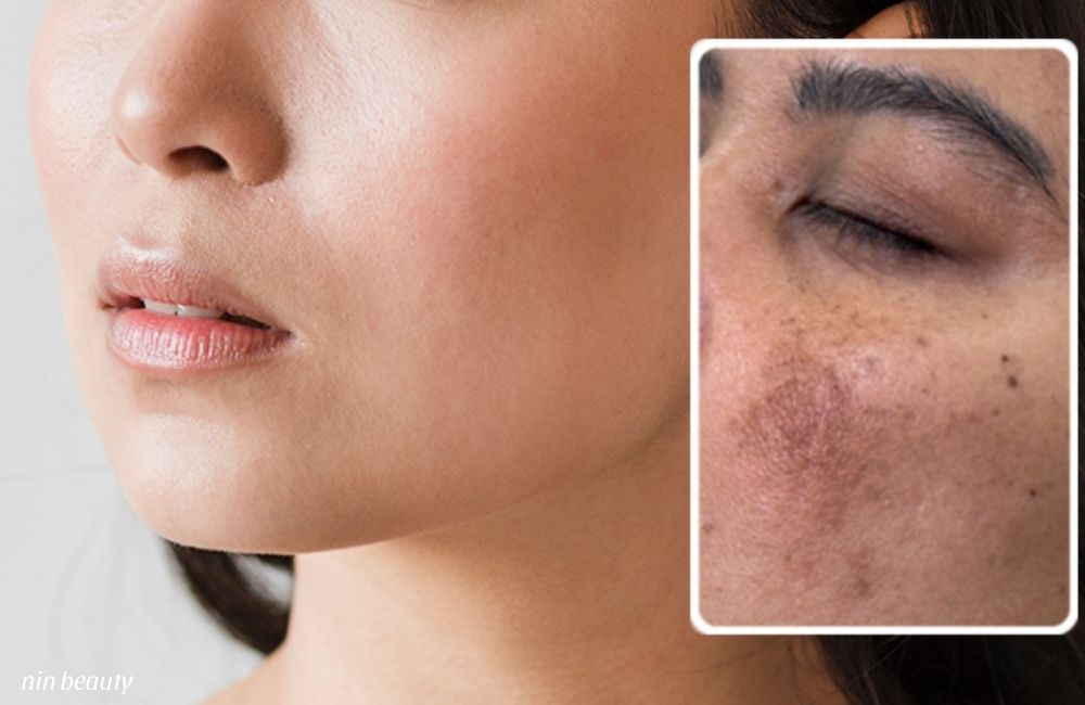 Giải Mã Cơ Chế Tái Phát Nám? Tại Sao Nám Rất Dễ Quay Trở Lại Sau Điều Trị?