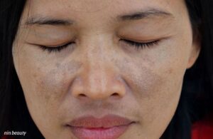 Nám Mảng Hay Nám Chân Sâu Bạn Đã Biết Cách Phân Biệt? 2 Nám Mảng Hay Nám Chân Sâu Bạn Đã Biết Cách Phân Biệt?