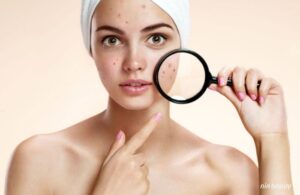 Những Lý Do Khiến Cho Vòng Lặp Mụn Mãi Không Kết Thúc Trên Làn Da Bạn