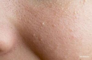 Lý Do Da Mọc Nhiều Mụn Trắng Vào Mùa Nồm? Chuẩn Đoán Da Tại Nhà