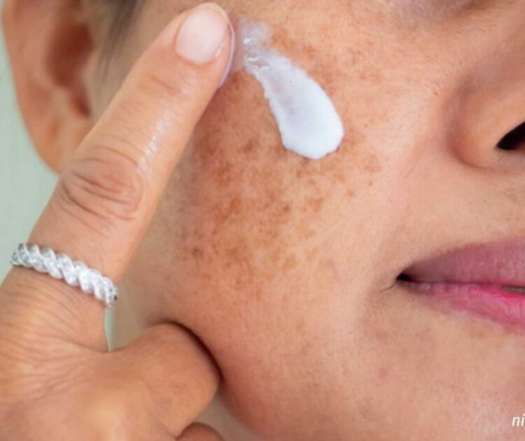 Những Sai Lầm Trong Bước Rửa Mặt Khiến Nám Nặng Hơn, Nguyên Nhân Ít Ai Ngờ Tới