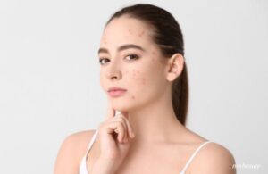 Làm Thế Nào Để Nhận Biết Da Đang Bùng Mụn Hay Đẩy Mụn?