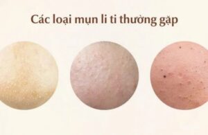 Lý Do Da Mọc Nhiều Mụn Trắng Vào Mùa Nồm? Chuẩn Đoán Da Tại Nhà