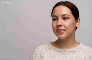 Làm Thế Nào Để Nhận Biết Da Đang Bùng Mụn Hay Đẩy Mụn?