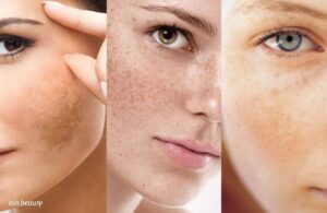 Giải Mã Cơ Chế Tái Phát Nám? Tại Sao Nám Rất Dễ Quay Trở Lại Sau Điều Trị?