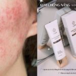 Kem Chống Nắng Cho Da Treatment, Da Treatment Cần Bảo Vệ Kỹ Càng