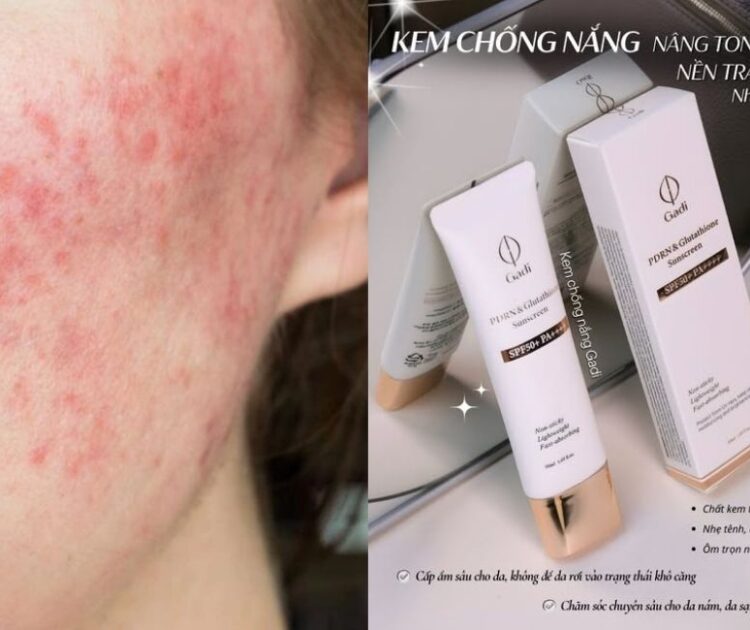 Kem Chống Nắng Cho Da Treatment, Da Treatment Cần Bảo Vệ Kỹ Càng