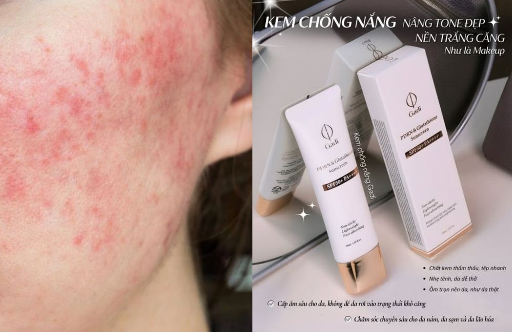 Kem Chống Nắng Cho Da Treatment, Da Treatment Cần Bảo Vệ Kỹ Càng