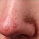 Nguyên Nhân Hay Mọc Mụn Viêm Ở Mũi Và Giải Pháp Ngay Tại Nhà 7 Nguyên Nhân Hay Mọc Mụn Viêm Ở Mũi Và Giải Pháp Ngay Tại Nhà