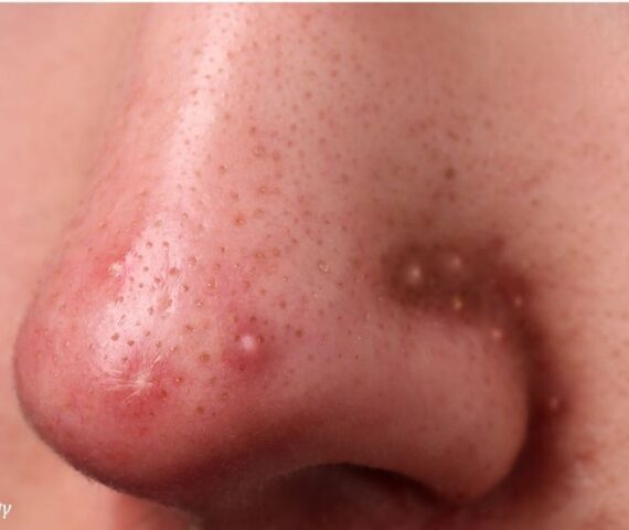 Nguyên Nhân Hay Mọc Mụn Viêm Ở Mũi Và Giải Pháp Ngay Tại Nhà