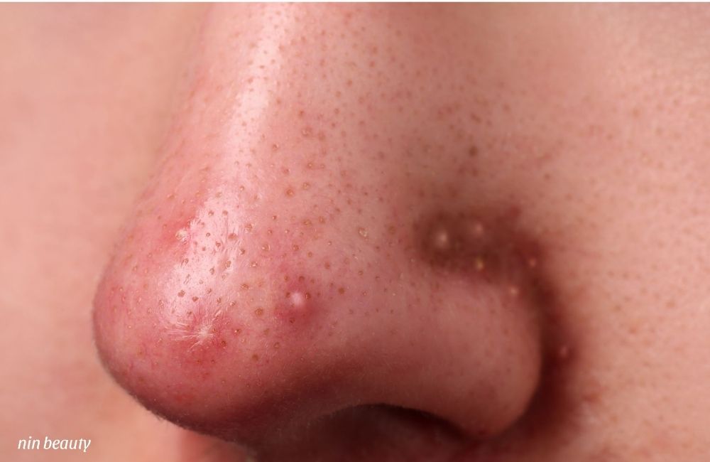 Nguyên Nhân Hay Mọc Mụn Viêm Ở Mũi Và Giải Pháp Ngay Tại Nhà