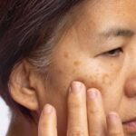 Sẽ Không Có Loại Kem Nám Nào Bôi Là Trị Được Sạch Nám 2 Sẽ Không Có Loại Kem Nám Nào Bôi Là Trị Được Sạch Nám