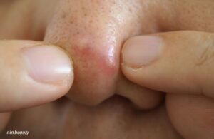 Nguyên Nhân Hay Mọc Mụn Viêm Ở Mũi Và Giải Pháp Ngay Tại Nhà