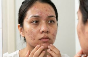 Da Nhiều Dầu Mụn Cần Rửa Mặt Mấy Lần Trong Một Ngày?