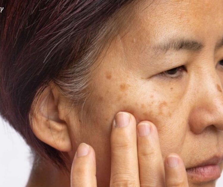 Sẽ Không Có Loại Kem Nám Nào Bôi Là Trị Được Sạch Nám