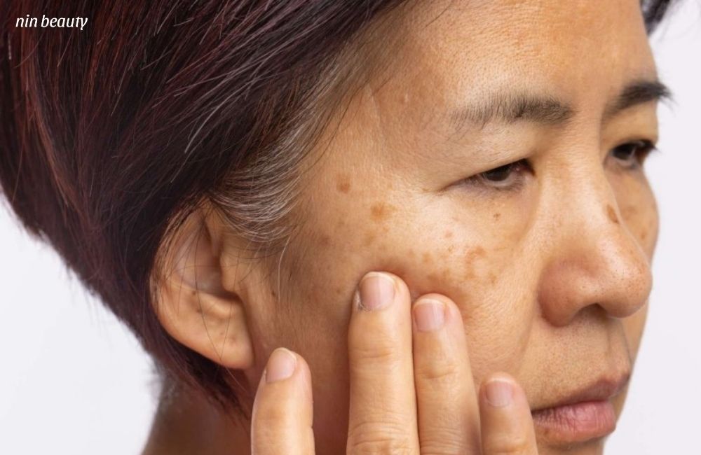 Sẽ Không Có Loại Kem Nám Nào Bôi Là Trị Được Sạch Nám