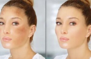 Nám Ở Độ Tuổi Trung Niên Liệu Còn Giải Pháp Cải Thiện Nào Không?