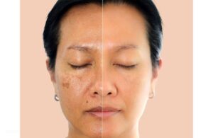 Sẽ Không Có Loại Kem Nám Nào Bôi Là Trị Được Sạch Nám